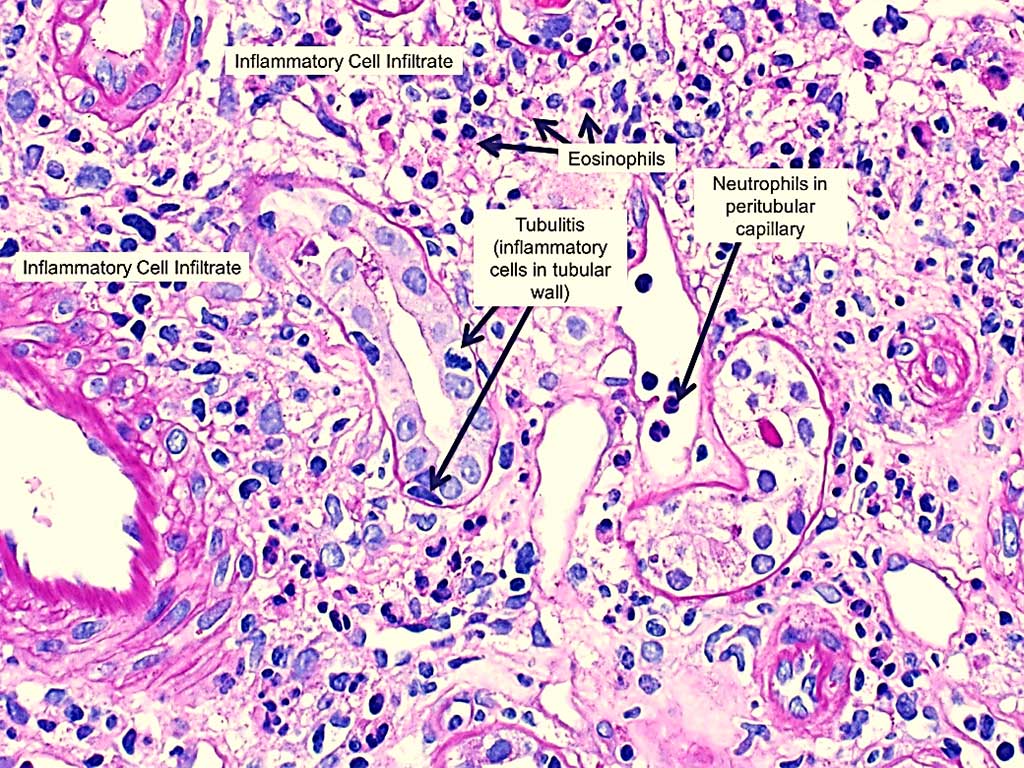 Image: Histopathology of drug-induced acute interstitial nephritis showing interstitial inflammation with prominent eosinophils and tubulitis (the presence of inflammatory cells within the tubular wall) (Photo courtesy of NephSim).