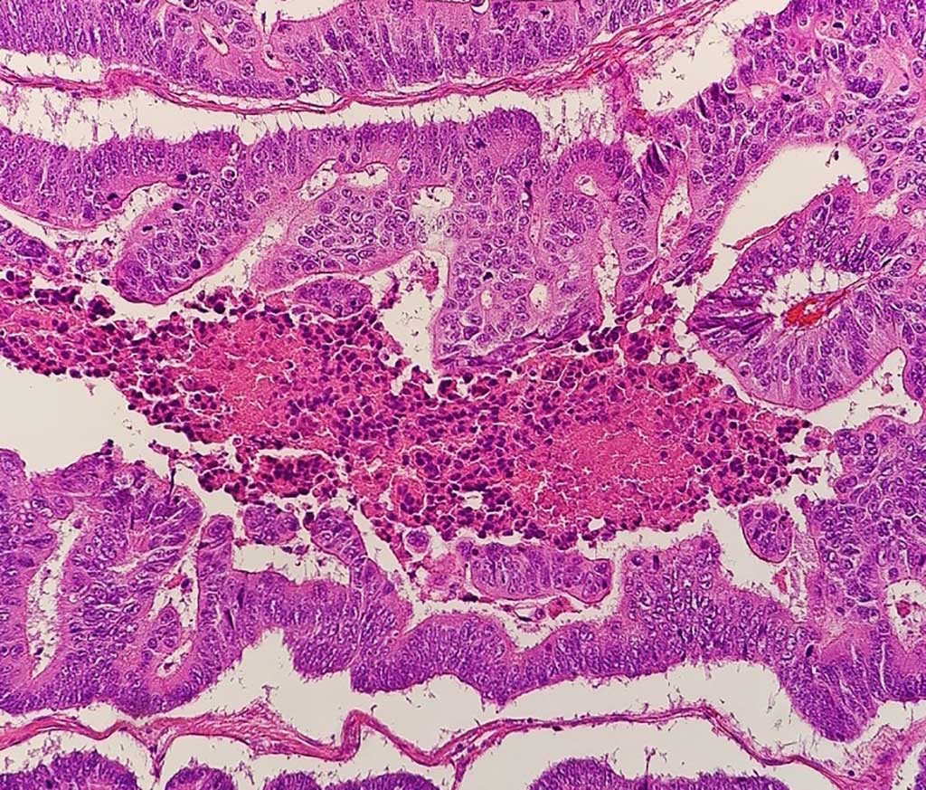 Image: Micrograph of a colorectal adenocarcinoma (Photo courtesy of Wikimedia Commons)