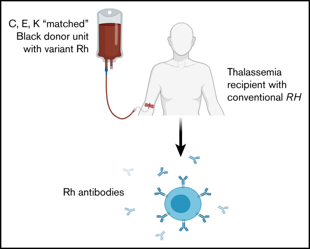 Image: Schematic diagram of Rh alloimmunization in chronically transfused patients with thalassemia receiving RhD, C, E, and K matched transfusions (Photo courtesy of The Children’s Hospital of Philadelphia).
