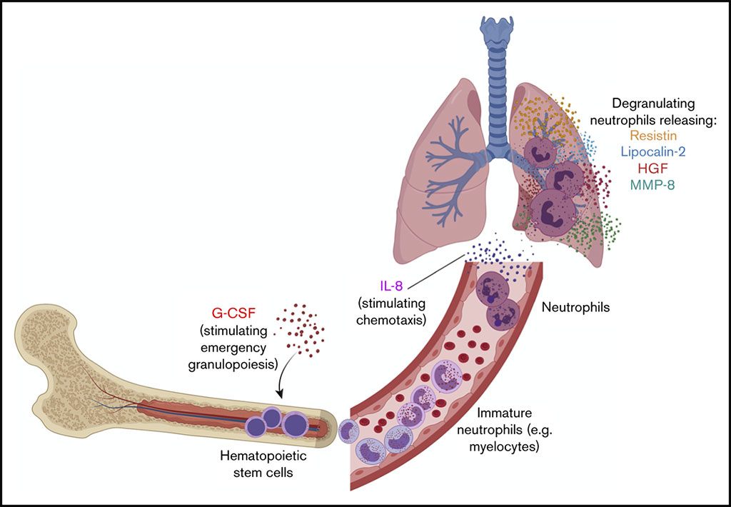 Image: Schematic diagram of a neutrophil activation signature predicting critical illness and mortality in COVID-19 (Photo courtesy of Yale School of Medicine).