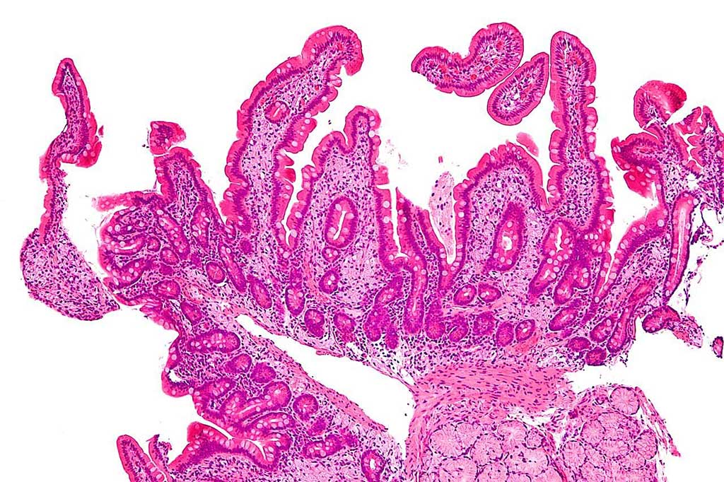 Image: Micrograph of Whipple’s disease. This duodenal biopsy shows the characteristic feature of Whipple’s disease; foamy macrophages are present in the lamina propria cells (Photo courtesy of Nephron).