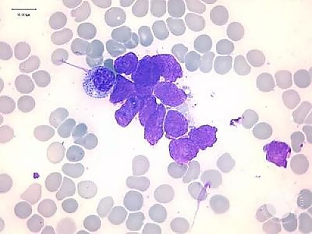 Image: Bone marrow aspirate from a child with a mediastinal tumor shows an invasion with neuroblastoma cells and characteristic images of neuropile threads (Photo courtesy of Mohammed Bensalah, MD, Amina Lyagoubi, and Rachid Seddik)