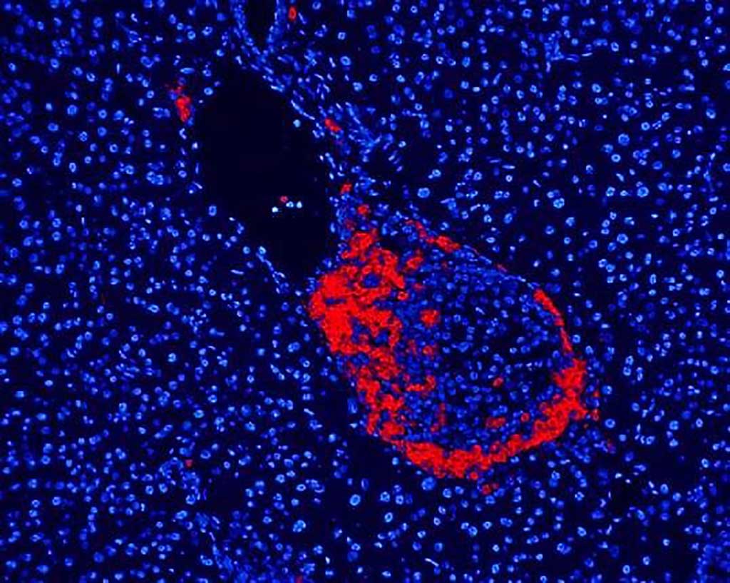 Image: Inflammation of the pancreatic islets with mononuclear cells including T-cells is the hallmark of Type 1 diabetes (Photo courtesy A. van Halteren)