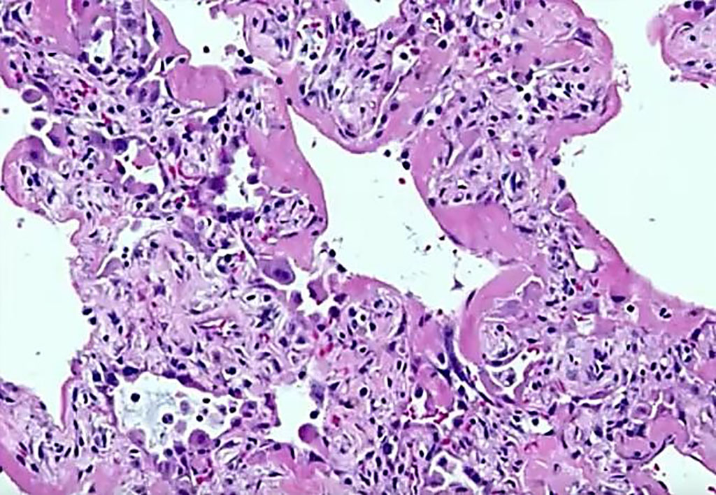 Image: Histopathology of the lung showing diffuse alveolar damage seen in patients who are infected with the COVID-19 virus (Photo courtesy of Sanjay Mukhopadhyay, MD)