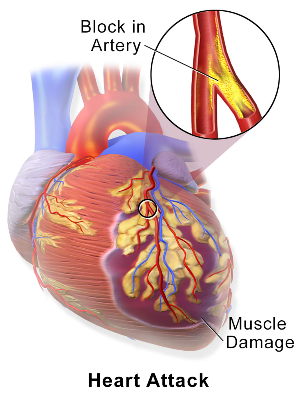 Image: A myocardial infarction (MI), commonly known as a heart attack, occurs when blood flow decreases or stops to a part of the heart, causing damage to the heart muscle (Photo courtesy of Wikimedia Commons)