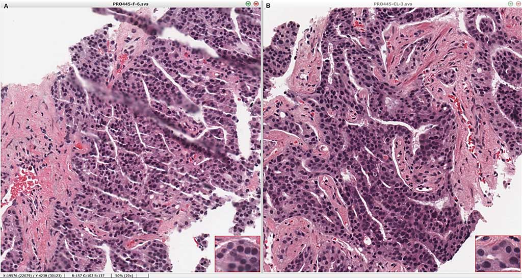 Image: Standard hematoxylin-eosin sections are unaffected by processing and imaging by clearing histology with multiphoton microscopy (CHiMP). Portions of the same core biopsy were submitted directly to standard processing (A) or processed by CHiMP and subsequently embedded in paraffin, sectioned, and stained (B), showing equivalent coloration and morphology (Photo courtesy of Yale School of Medicine)