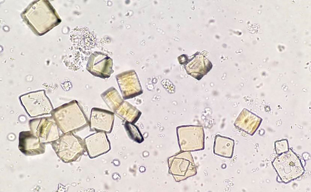 Image: Photomicrograph of uric acid crystals in urine sediment (Photo courtesy of cannablysss)