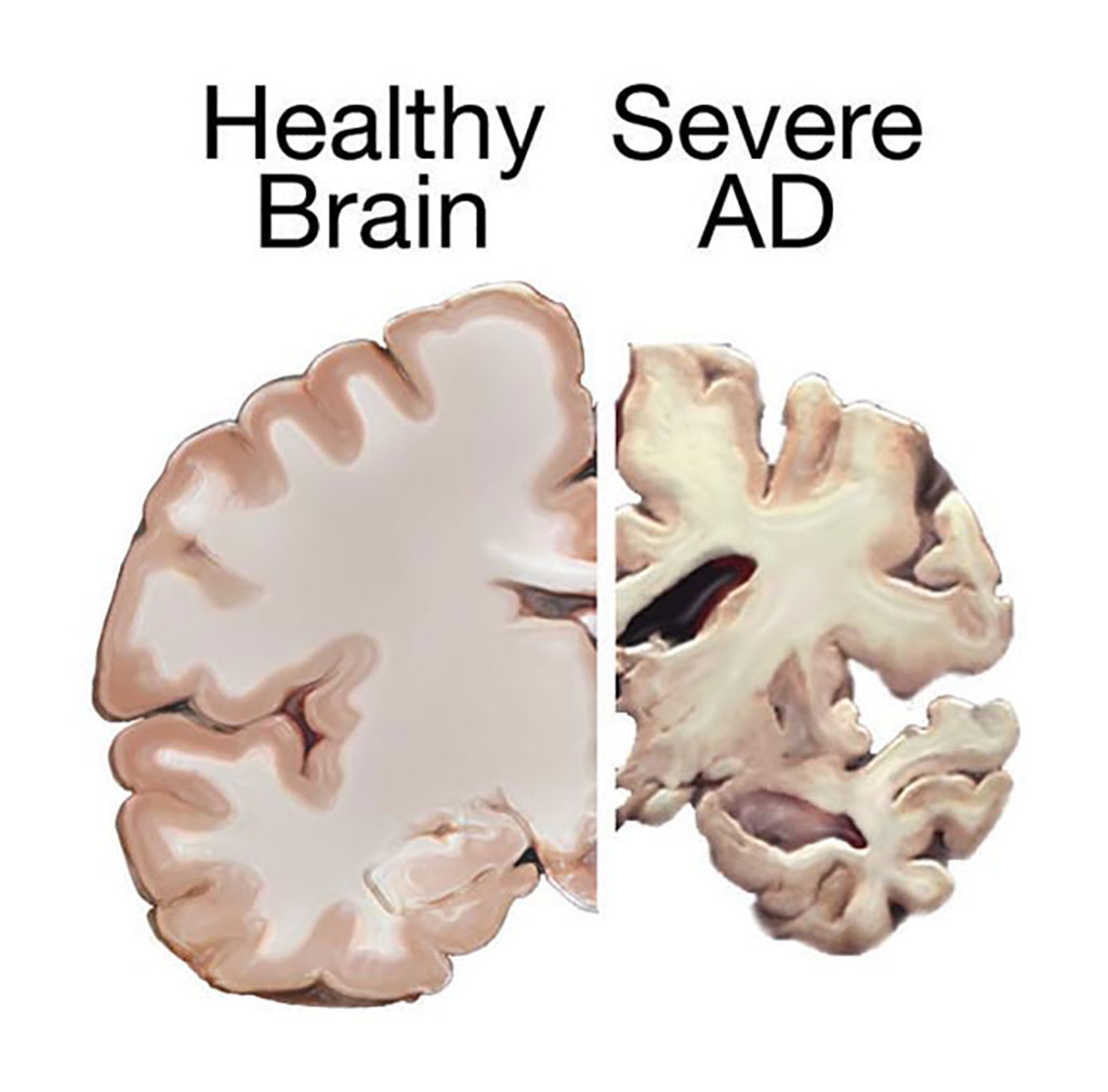 Image: Comparison of brain tissue from a healthy individual and an Alzheimer\'s disease (AD) patient, demonstrating extent of neuronal death (Photo courtesy of [U.S.] National Institutes of Health via Wikimedia Commons)