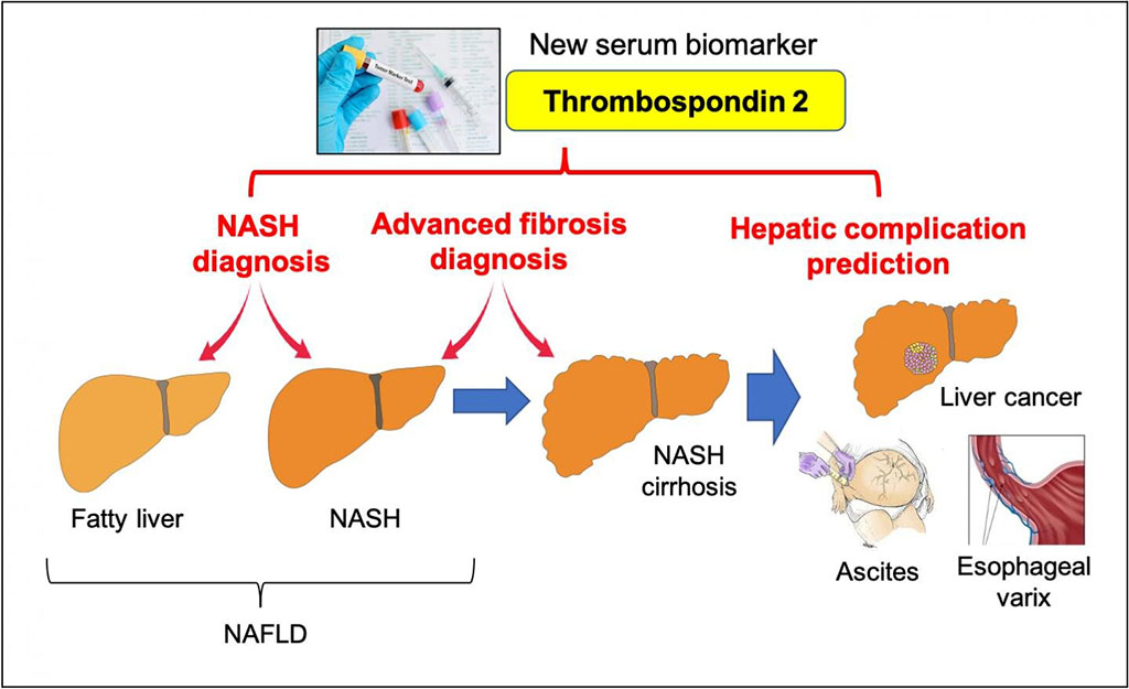 Image: Thrombospondin 2 is a new diagnostic and prognostic serum biomarker in NAFLD (Photo courtesy of Osaka University)