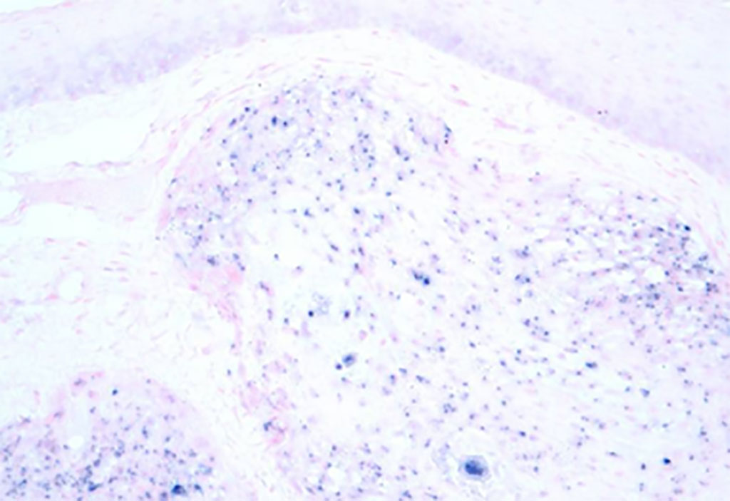 Image: Micrograph image of human papilloma virus associated oropharyngeal cancer (HPV+ OPSCC). The tissue was stained to show the presence of the virus by in situ hybridization (Photo courtesy of Wikimedia Commons)