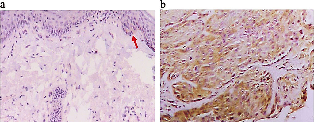 Image: Immunohistochemical (IHC) analysis of the normal tissue from a healthy subject showed several Matrix Metalloproteinase-13 (MMP-13) positive cells (light brown staining indicated by the red arrow in panel a. Panel b is an IHC microphotograph for the cSCC tissue, and brown staining can be seen in most of tumor cells (Photo courtesy of Weifang People’s Hospital)