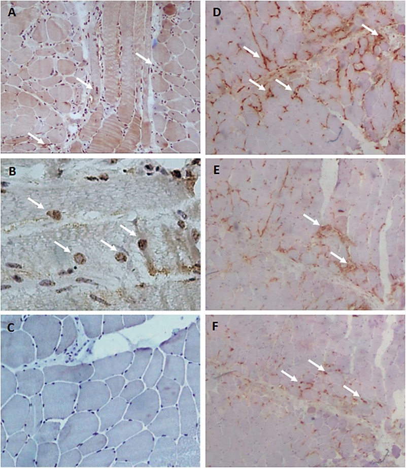 Antisynthetase Syndrome Patients with positive immunohistochemistry reaction of (A) YKL-40, (B) YKL-40 (higher magnification); (C), a specimen from a patient with antisynthetase syndrome, but without infiltrate inflammation; (D) CD68, (E) CD4, and (F) CD8 (Photo courtesy of Universidade de Sao Paulo).