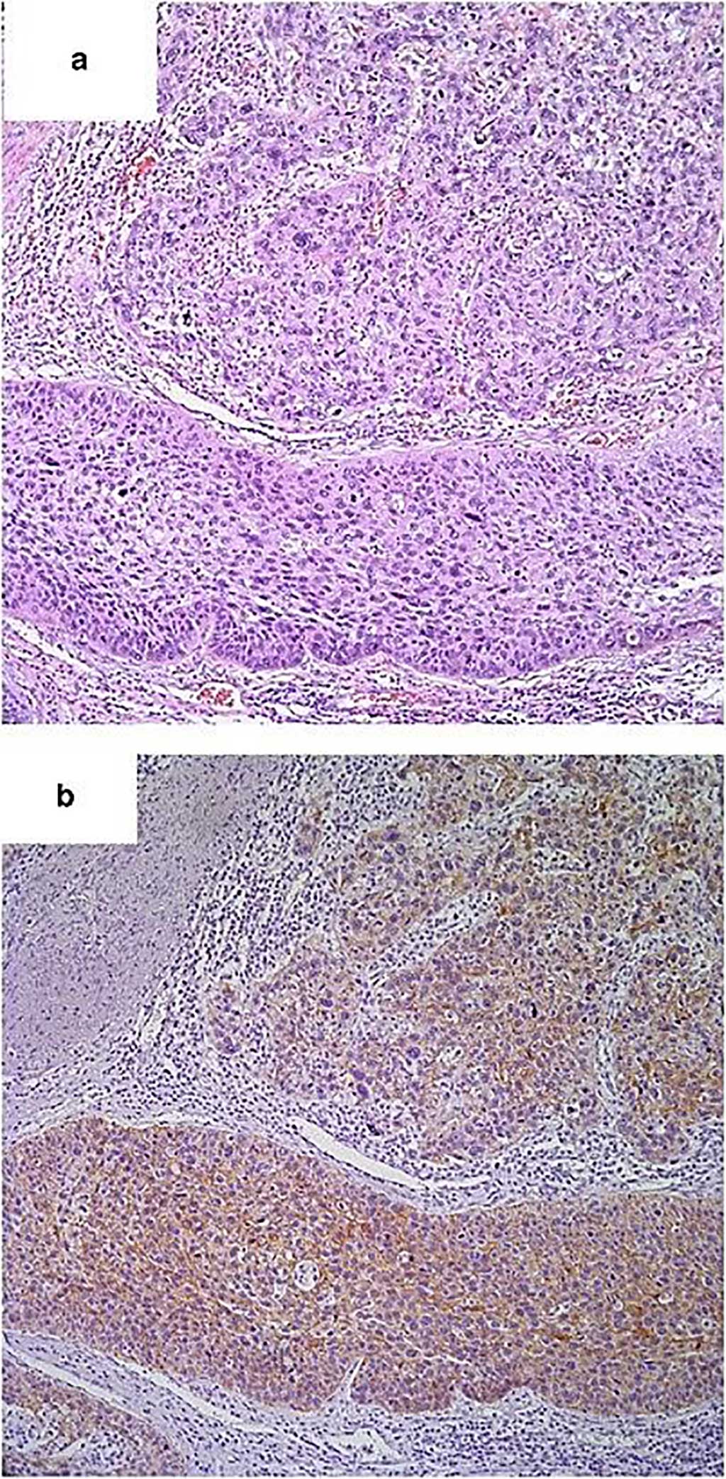 Image: Histopathology of (a) Usual-type high-grade urothelial carcinoma and (b) Positive E-cadherin expression in usual-type high-grade urothelial carcinoma. (Photo courtesy of Emory University School of Medicine)