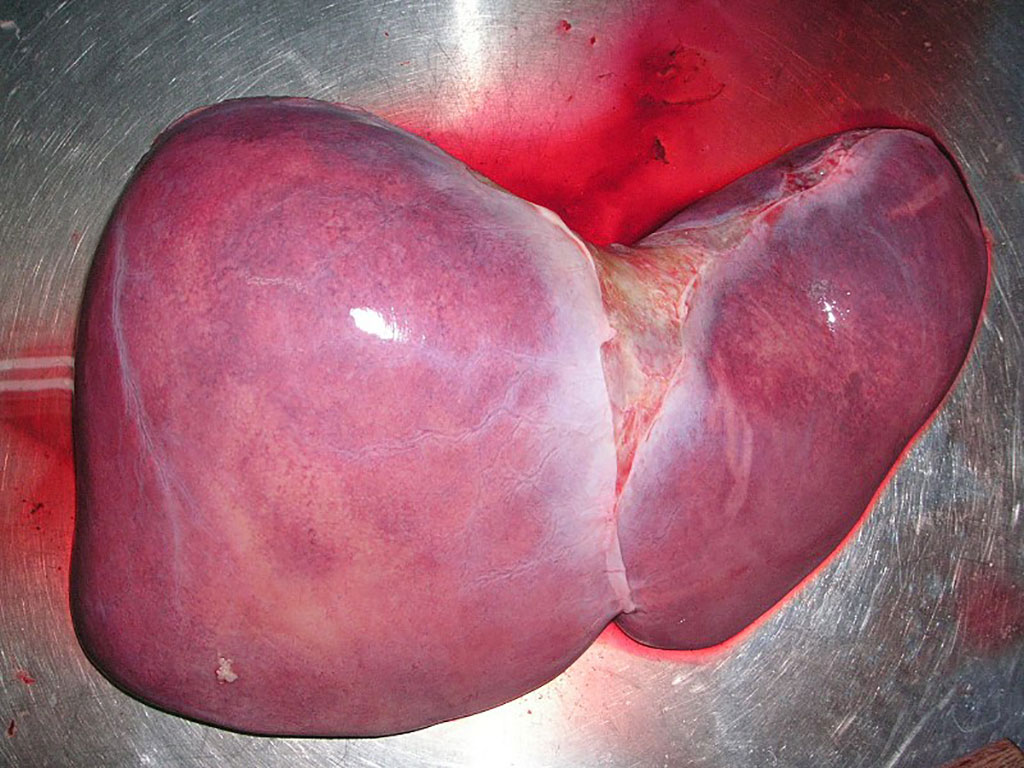 Image: A healthy human liver. A biomarker linked to the organ donor predicts the likelihood that a transplanted liver will be accepted or rejected by the recipient of the organ (Photo courtesy of  Wikimedia Commons)