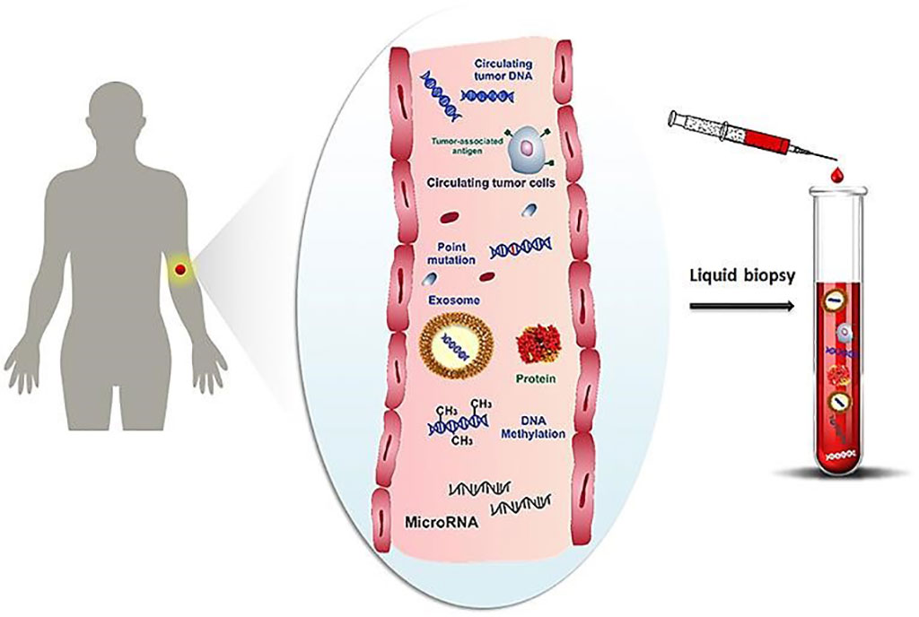 Image: Schematic representation of cancer-related biomolecules such as cells, proteins, nucleic acids, miRNA and microvesicles circulating into the bloodstream, and collection of these biomarkers by liquid biopsy (Photo courtesy of University of Florence)