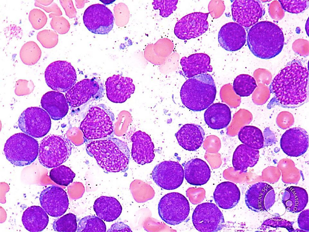 Image: Bone marrow aspirate from a patient with Acute Myeloid Leukemia: Blasts are the predominant population and have a high nuclear to cytoplasmic ratio and generally lack granules. (Photo courtesy of Professor Peter G. Maslak, MD)