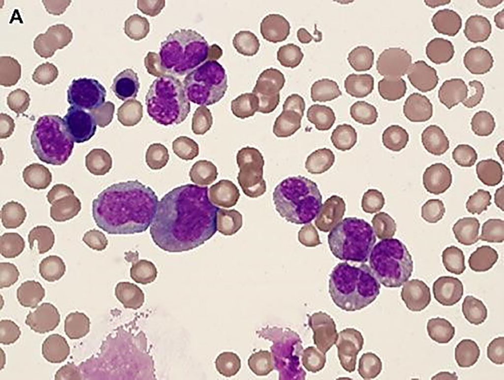 Image: Bone marrow biopsy from a patient with severe Shwachman-Diamond Syndrome, hypocellular marrow; scattered mild dysplastic changes in all cell lines; may have prominent hematogones (Photo courtesy of Dragos C. Luca, MD)