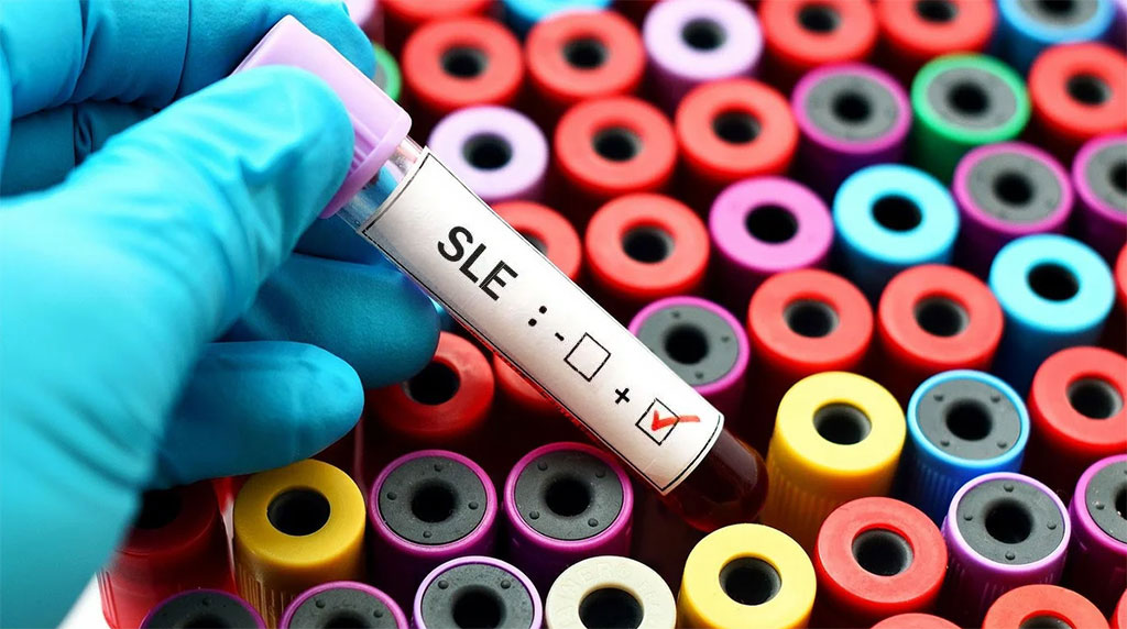 Image: An SLE (systemic lupus erythematosus) positive sample (Photo courtesy of 123rf.com)