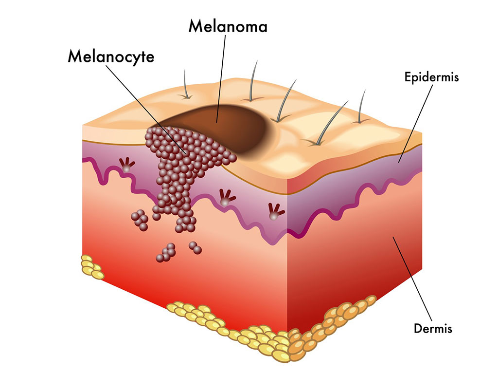 Image: Schematic of melanoma (skin cancer) (Photo courtesy of 123rf.com)