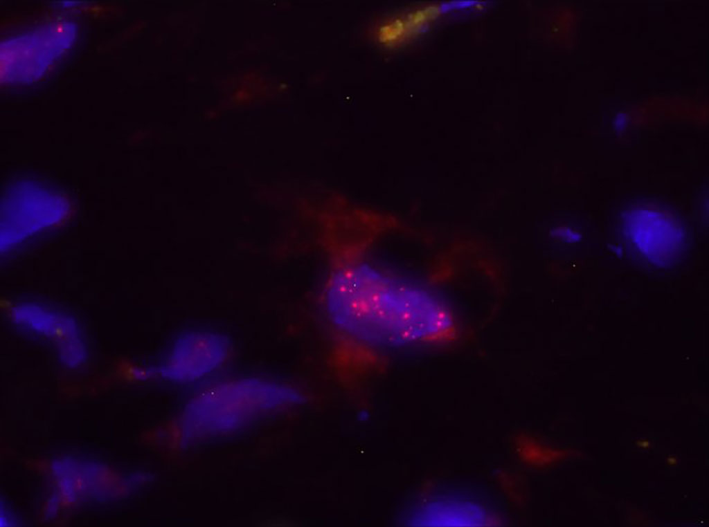 Image: In red, Bacteroides, one of the microorganisms identified in this work, inside nucleus of a pancreatic cell, in blue (Photo courtesy of CNIO)
