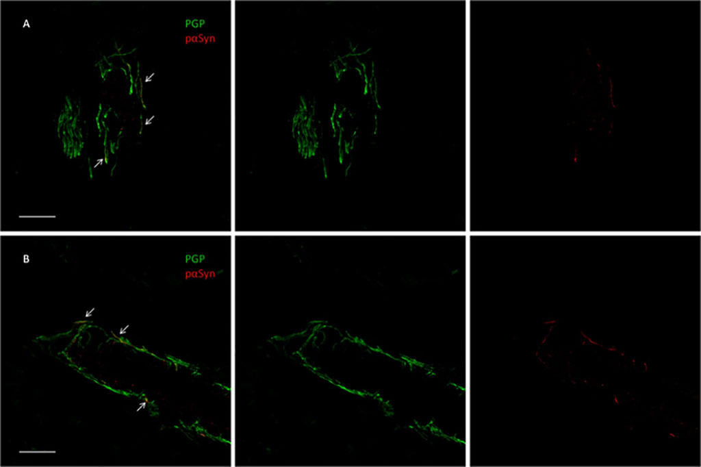 Image: Confocal microscope study of p-syn deposits in a dermal arteriole of a patient with PD (Photo courtesy of Dr. Alex Incensi)