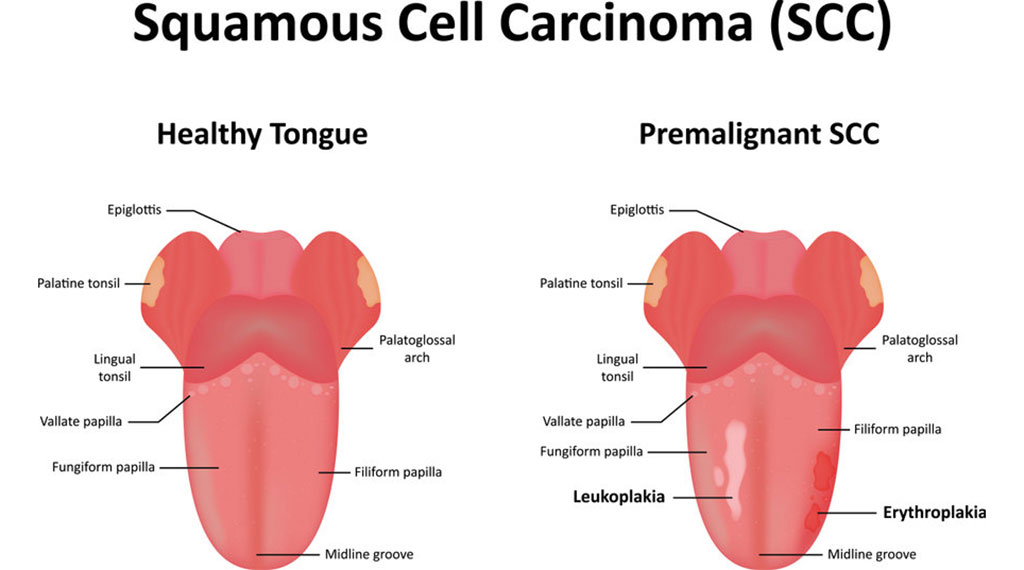 Image: Oral squamous cell carcinoma (Photo courtesy of 123rf.com)