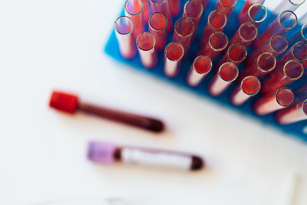 Image: A blood test could help diagnose skin cancer (Photo courtesy of Pexels)