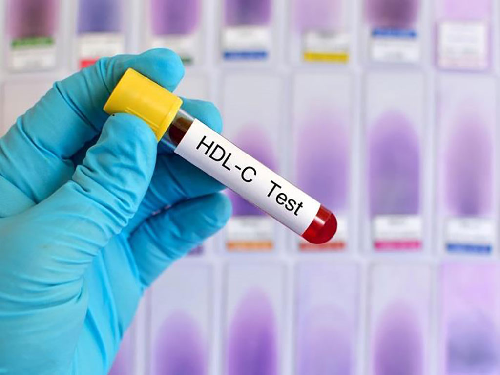 Image: High-density lipoprotein cholesterol levels are associated with adverse cardiovascular outcomes in high-risk populations (Photo courtesy of Infomed Digital Health)