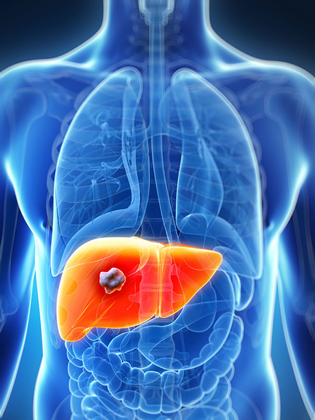 Image: Liver cancer is the third-leading cause of cancer-related deaths worldwide (Photo courtesy of Delfi Diagnostics)