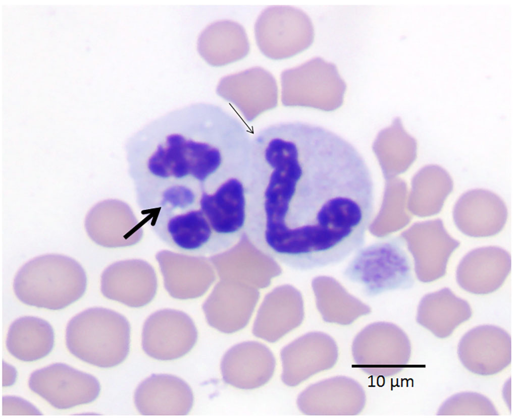 Image: Anaplasma phagocytophilum morulae (arrowed) in the cytoplasm of white blood cells (Photo courtesy of Johan S.Bakken, MD, PhD and Stephen Dumler, MD)