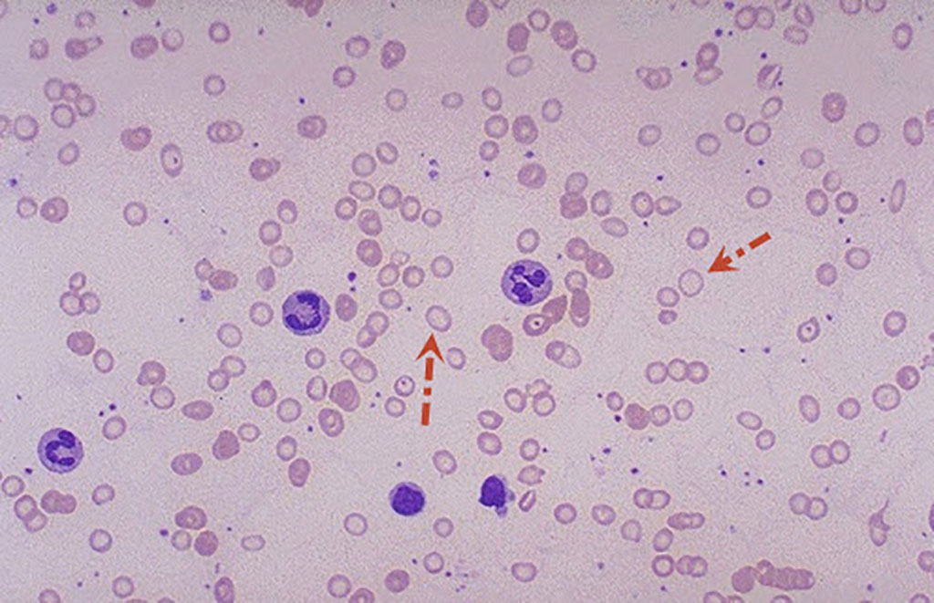 Microcytic Hypochromic Anemia: Causes and Diagnosis - Pathology Made ...