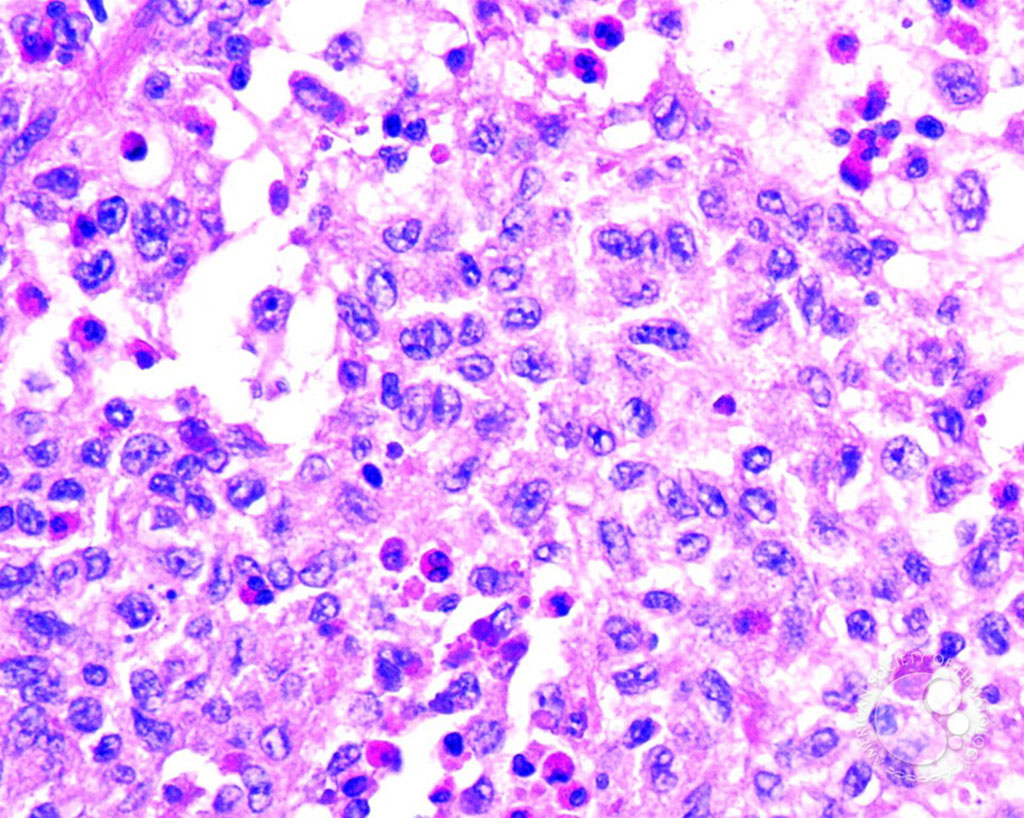 Image: Histopathology of Langerhans cell histiocytosis: The variation in nuclear contours of these cells is evident in this lesion. Classic `kidney bean` nuclei of Langerhans cells with a central groove are present (Photo courtesy of John Lazarchick, MD)