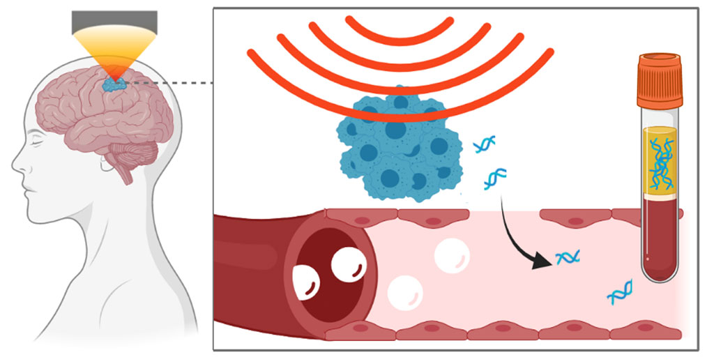 Image: Focused ultrasound technique has led to release of neurodegenerative disorders biomarkers (Photo courtesy of Washington University in St. Louis)