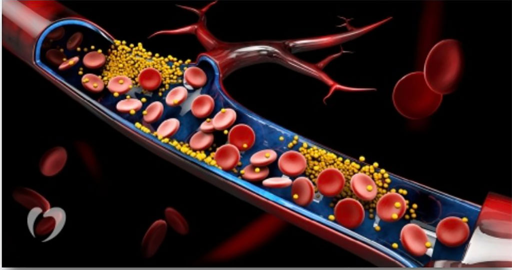 Image: ApoB may be a more accurate risk predictor of atherosclerotic cardiovascular disease (Photo courtesy of Intermountain Health)