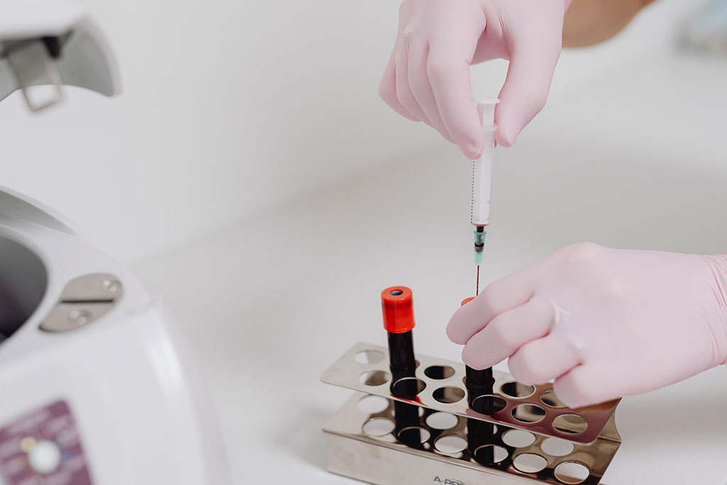 Image: Epilepsy could now become easier to pinpoint with a blood test (Photo courtesy of Pexels)