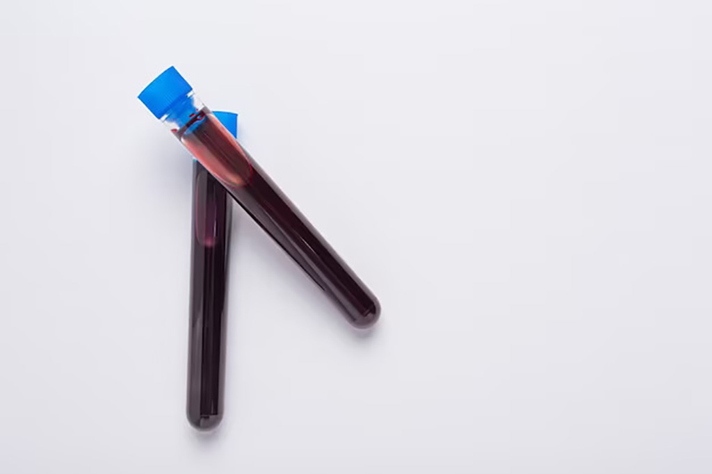 Image: Researchers are working towards a ‘transformative’ early blood test for Alzheimer’s (Photo courtesy of Freepik)