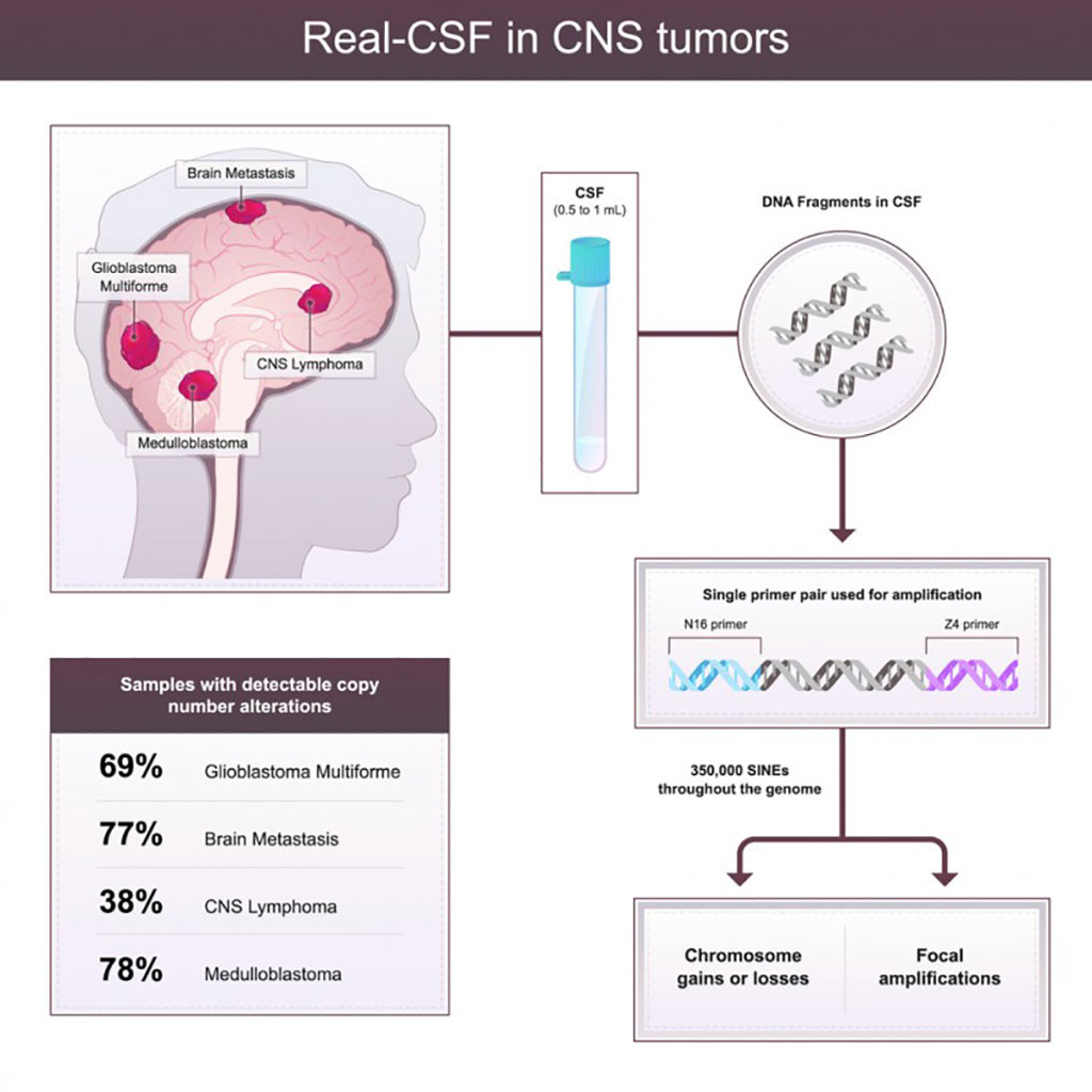 Image: The Real-CSF test measures abnormal genetic material circulating in cerebrospinal fluid (Photo courtesy of Johns Hopkins)