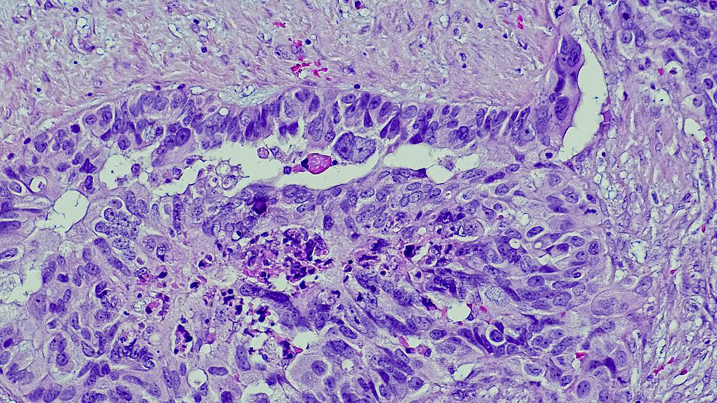 Image: High-grade serous ovarian carcinoma (HGSOC) is the most common type of ovarian cancer (Photo courtesy of USC)