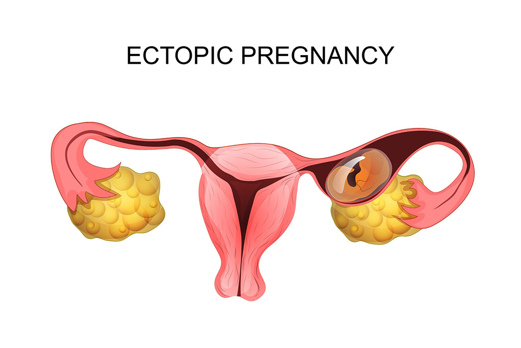 Image: Ectopic pregnancy primarily occurs in the fallopian tubes but may arise in other sites (Photo courtesy of 123RF)