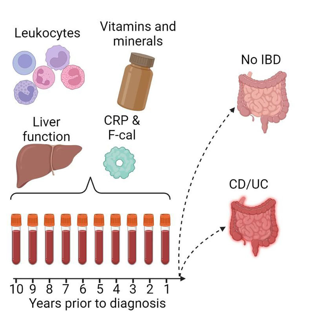 Image: The researchers looked at several clinical tests up to 10 years before inflammatory bowel disease diagnosis (Photo courtesy of M. Cell Reports Medicine)