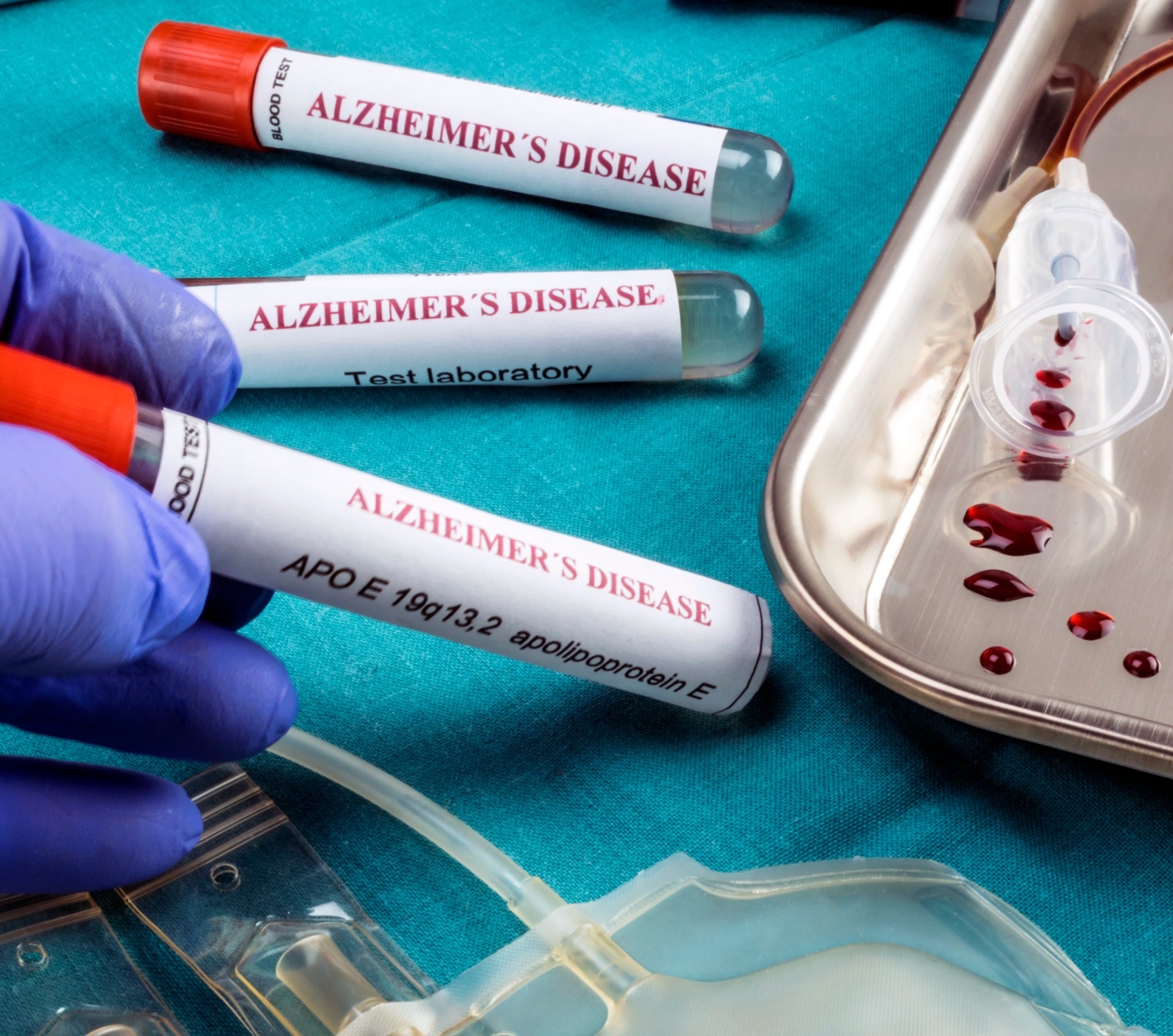 Image: Midlife blood AD biomarker assessments may serve as early predictors of cognitive decline (Photo courtesy of 123RF)