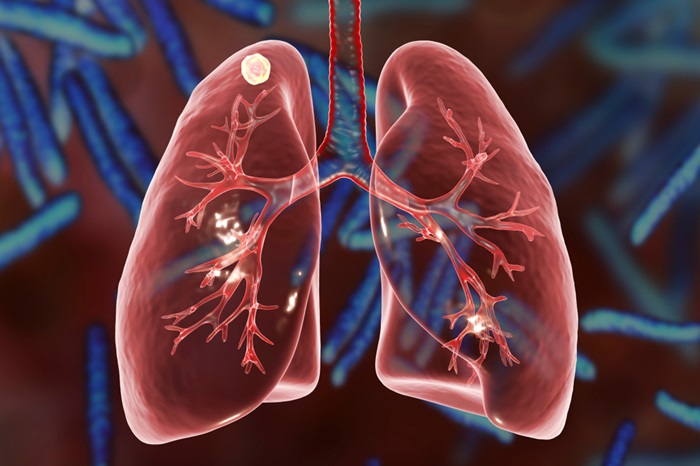 Image: The new tuberculosis test could improve TB care globally (Photo courtesy of Shutterstock)