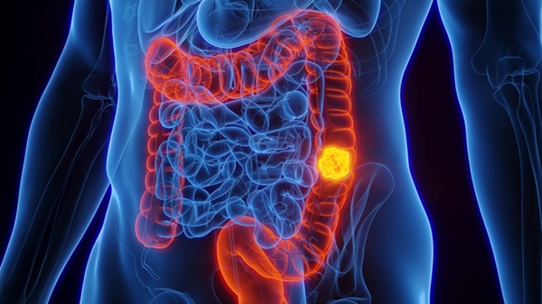 Image: An AI bowel cancer test can tell whether patients need chemotherapy (Photo courtesy of Shutterstock)