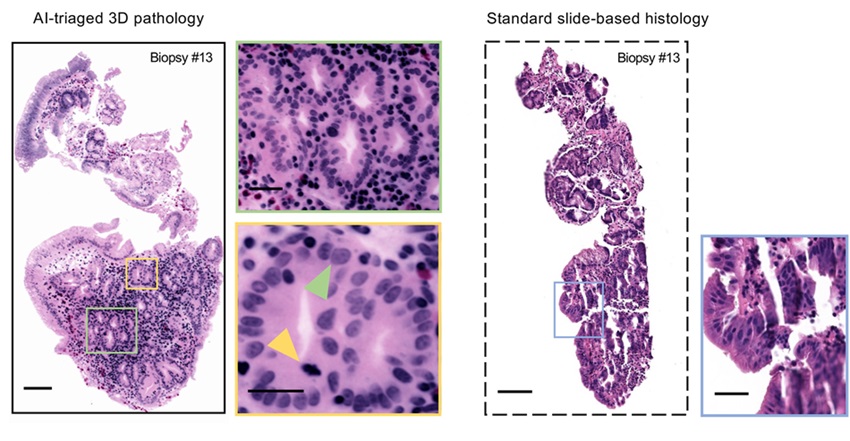 Image: Examples of AI-triaged 3D image sections of a biopsy show how 3D pathology (left) upgraded the diagnosis compared with conventional 2-dimensional methods (right) (Photo courtesy of UW College of Engineering)