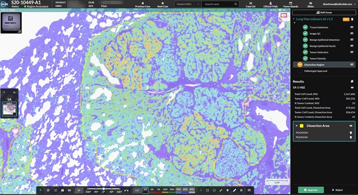 Image: Lung Macrodissect AI quantifies tumor content, streamlines tumor annotation, and ensures specimen quality for downstream analysis (Photo courtesy of Indica Labs)