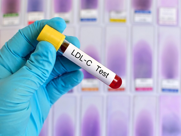 Image: U.S. guidelines may miss vulnerable patients whose cholesterol levels appear within healthy range (Photo courtesy of 123RF)