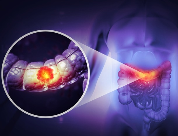 Image: The bowel cancer breakthrough could result in better treatment outcomes (Photo courtesy of 123RF)