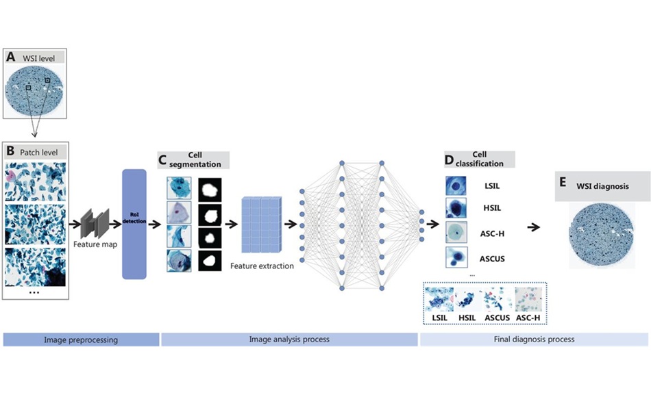 Image: Schematic representation of AI-assisted cervical cytology image analysis (Photo courtesy of Cancer Biology & Medicine, DOI:10.20892/j.issn.2095-3941.2024.0198)