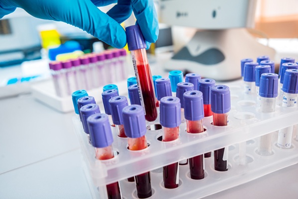 Image: The blood test for fungal infections provides faster results and has a less invasive process (Photo courtesy of 123RF)