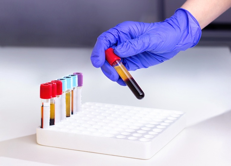 Image: The new blood test could detect bowel cancer when it is more treatable (Photo courtesy of 123RF)